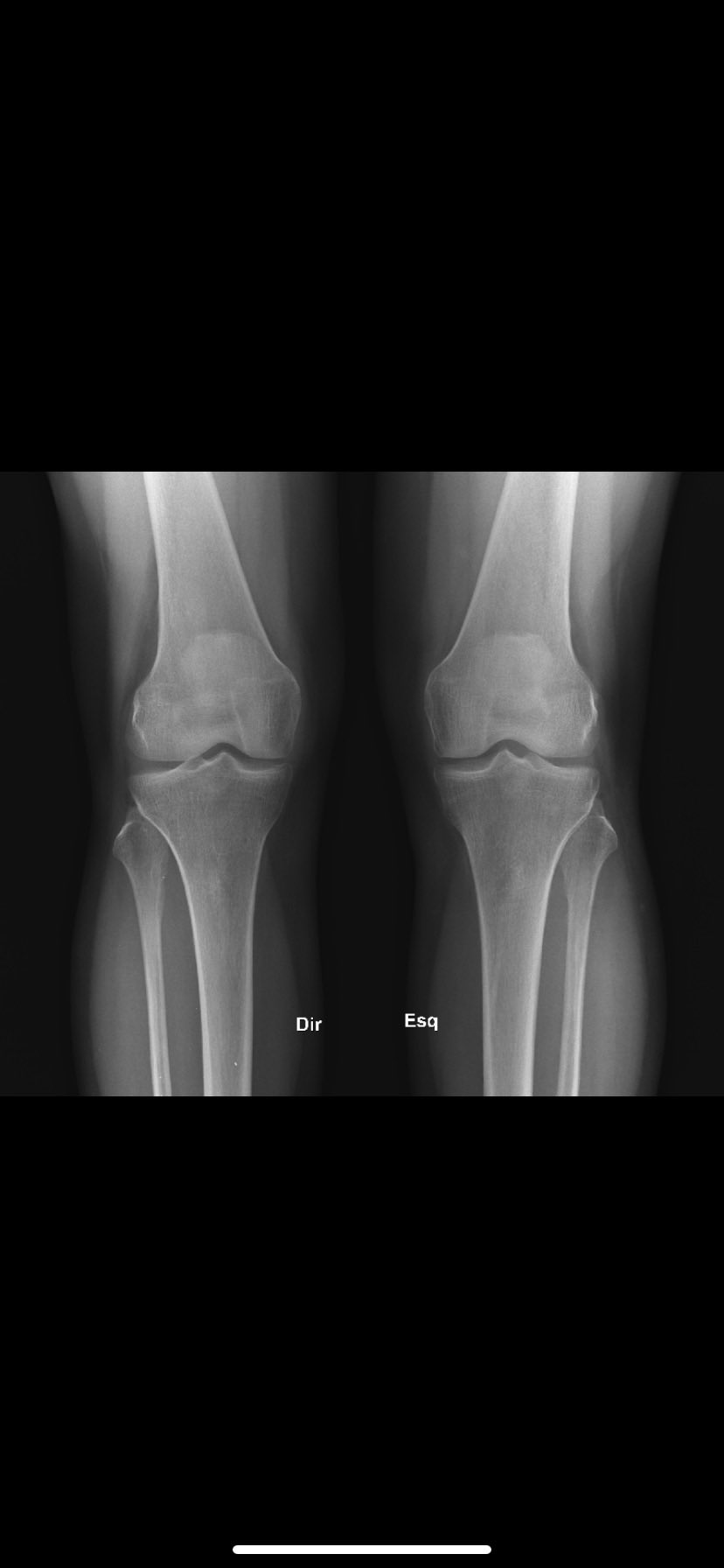 Bret on Twitter "I took an xray of my knees the other day. Fun to see