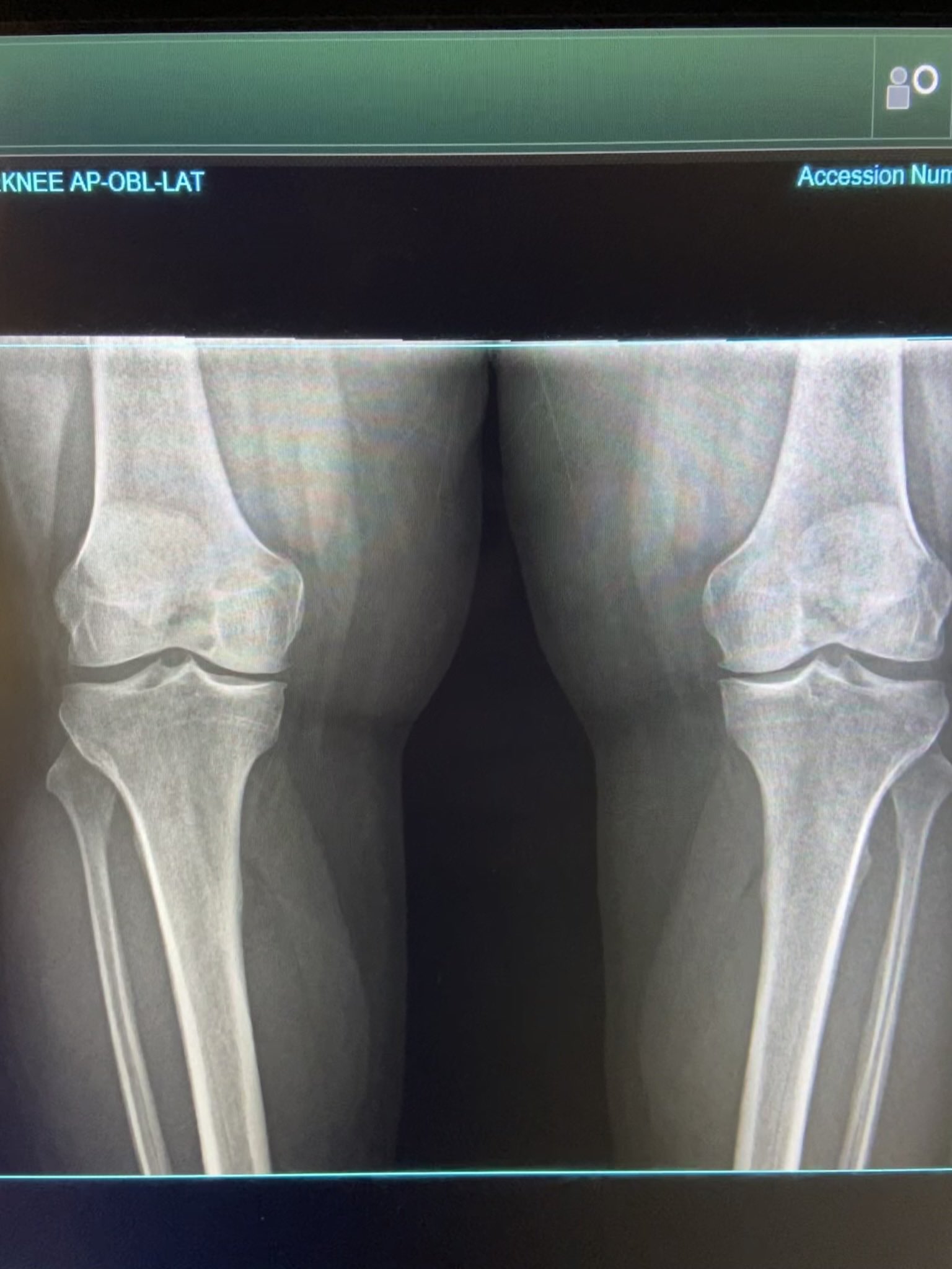 Bret on Twitter "I took an xray of my knees the other day. Fun to see