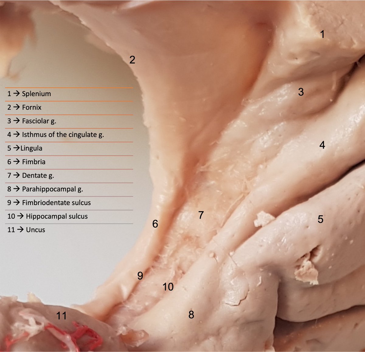 #Splenium #Fornix #Fasciolargyrus #Isthmus #Lingula
#Fimbria #Dentategyrus #Parahippocampalgyrus #Fimbriodentatesulcus #Hippocampalsulcus #Uncus