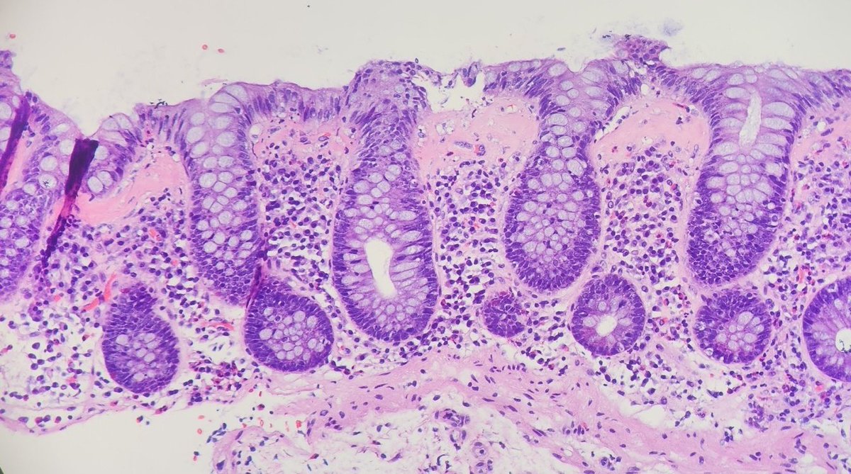 Classic #GIpath.

#pathology #GIPath #PathTwitter #PathMatch23