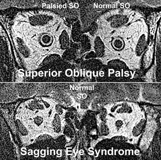 ARVOiovs's tweet image. Qi Wei,  Robert A. Clark &amp;amp; Joseph L. Demer @UCLAHealth @UCLA_BRI discuss whether binocular alignment can distinguish hypertropia in sagging eye syndrome from superior oblique palsy.
doi.org/10.1167/iovs.6…