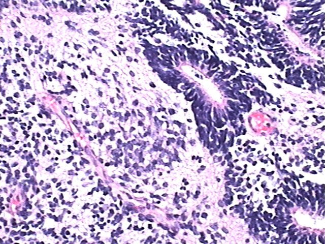 Felipe D'Almeida (@FelipePatologia) on Twitter photo 2022-09-22 15:35:22 Just a bit of an Embryonal tumor with multilayered rosettes, an aggressive embryonal tumor of childhood. Most cases have amplification of C19MC locus. Rare cases are associated with DICER1 mutations. #PathTwitter #NeuroPath Just a bit of an Embryonal tumor with multilayered rosettes, an aggressive embryonal tumor of childhood. Most cases have amplification of C19MC locus. Rare cases are associated with DICER1 mutations. #PathTwitter #NeuroPath