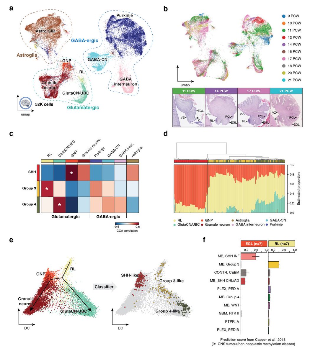 Dr Kish Mankad (@drmankad) on Twitter photo 'Unified rhombic lip origins of group 3 and group 4 medulloblastoma': pubmed.ncbi.nlm.nih.gov/36131015/
Matter of great honor to have coauthored this groundbreaking study <a href="/Nature/">nature</a> with the honorable Zoltan Patay. Special thanks to @drpaulnorthcott and @parthivhaldipur! Some heat maps here: 'Unified rhombic lip origins of group 3 and group 4 medulloblastoma': pubmed.ncbi.nlm.nih.gov/36131015/
Matter of great honor to have coauthored this groundbreaking study <a href="/Nature/">nature</a> with the honorable Zoltan Patay. Special thanks to @drpaulnorthcott and @parthivhaldipur! Some heat maps here: