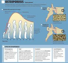 bvscuba's tweet photo. Día Internacional de la Osteoporosis Guía para el diagnóstico y tratamiento osteoporosis https://t.co/zvGSKJA2vq https://t.co/GoVj50PfNt