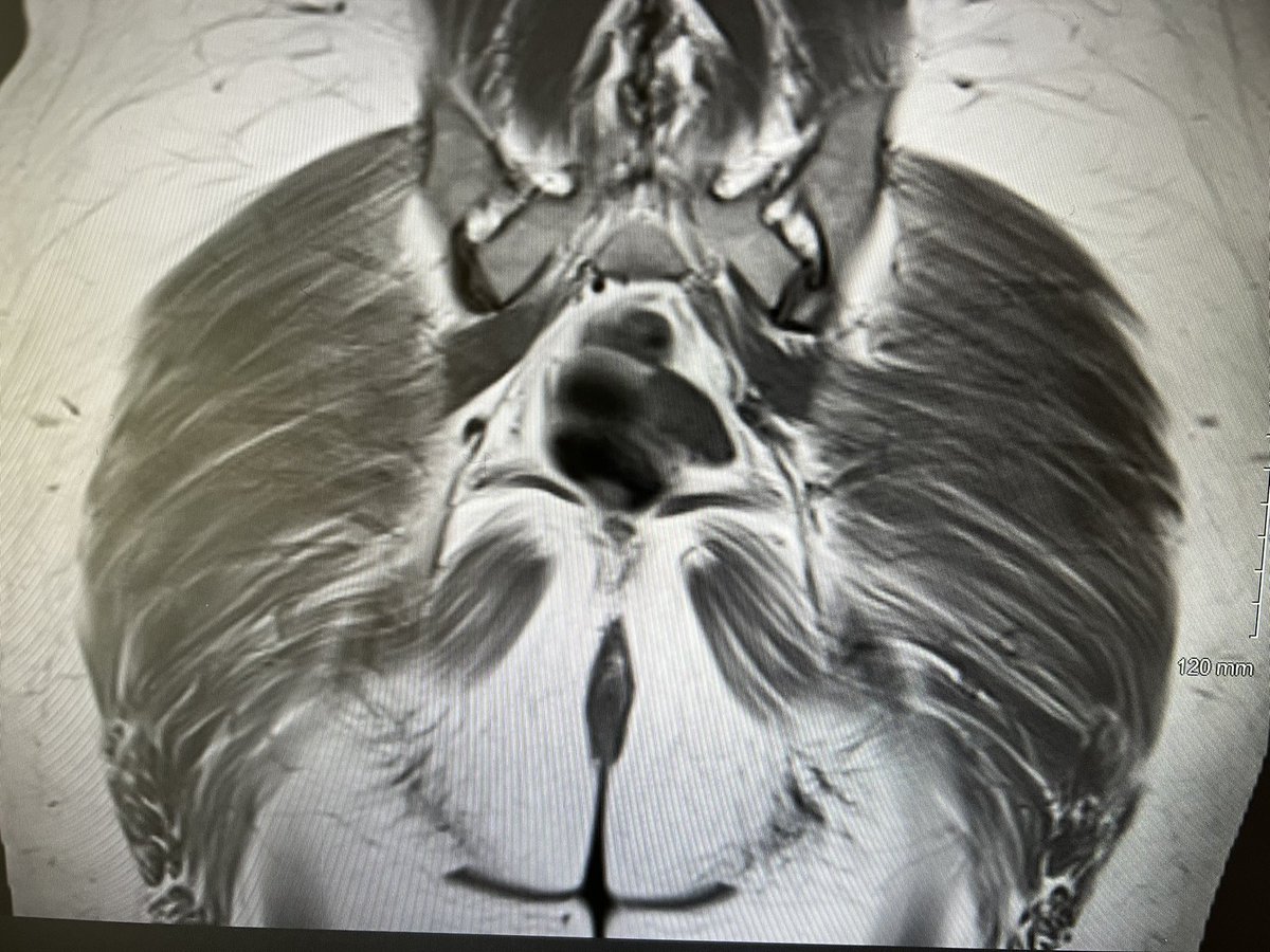 I think we should be commenting more on muscle conditioning on MRI. 

This lady has bilateral trochanteric bursitis and obvious global gluteal muscle deconditioning (streaky muscles with fatty infiltrates!) For me, this is the more important finding above an inflamed bursa.