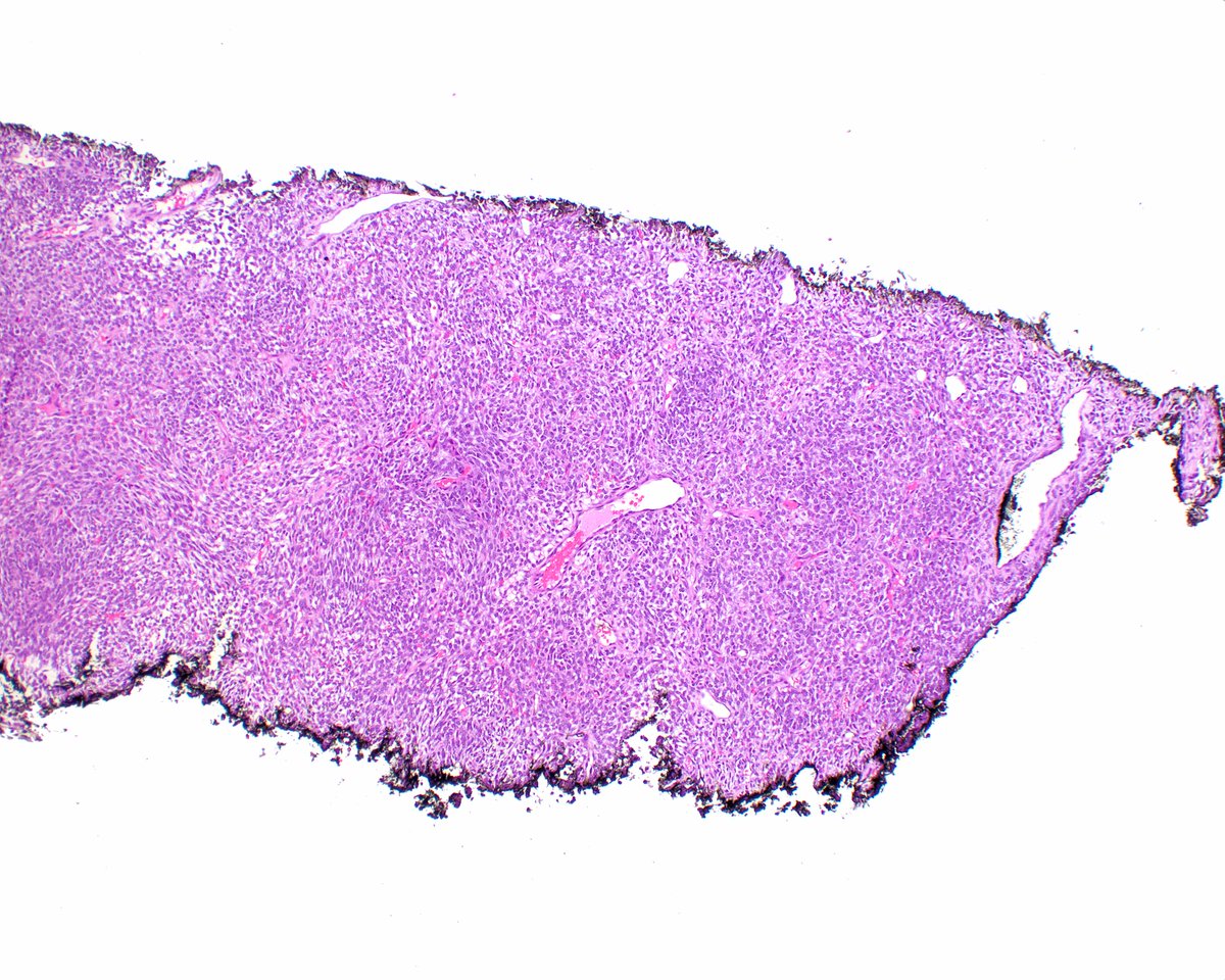 LizMontgomeryMD's tweet photo. This synovial sarcoma presented as a breast lesion!  Good gosh. https://t.co/2LI4f6JWMa
