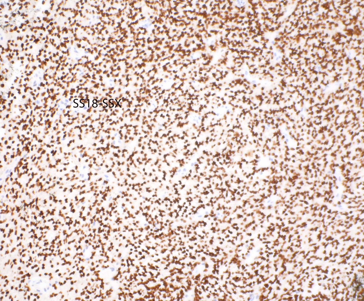 This synovial sarcoma presented as a breast lesion!  Good gosh.