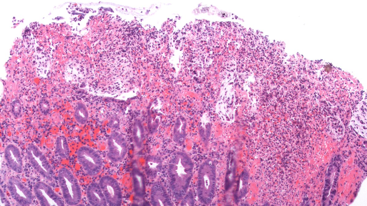 Pseudomembranous colitis (PC) secondary to Clostridium difficile infection 'Volcano' 🌋 lesion (left image) and pseudomembranes (left and right images) composed of fibroinflammatory debris For poll, see 🧵 #pathology #GIpath #medtwitter #GItwitter #PathMatch23 #PathResidents