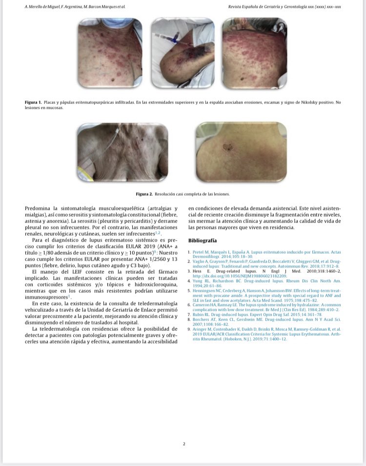 GeriatriaLaPaz's tweet photo. Hidralazina como probable causante de toxicodermia. Interesante caso clínico valorado a través de  teledermatología por el equipo de Geriatría de Enlace con residencias ⬇️ https://t.co/X2NFvY2c4q https://t.co/o18SiiSBCF
