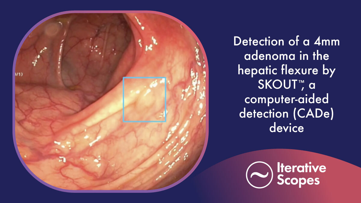 We’re thrilled to announce that our real-time, computer-aided, polyp detection device SKOUT™ has received 510(k) clearance from the FDA. Read our new release to learn more about our registration study. SKOUT is not yet for sale in the US. <a href="/provationmed/">Provation</a> 

businesswire.com/news/home/2022…