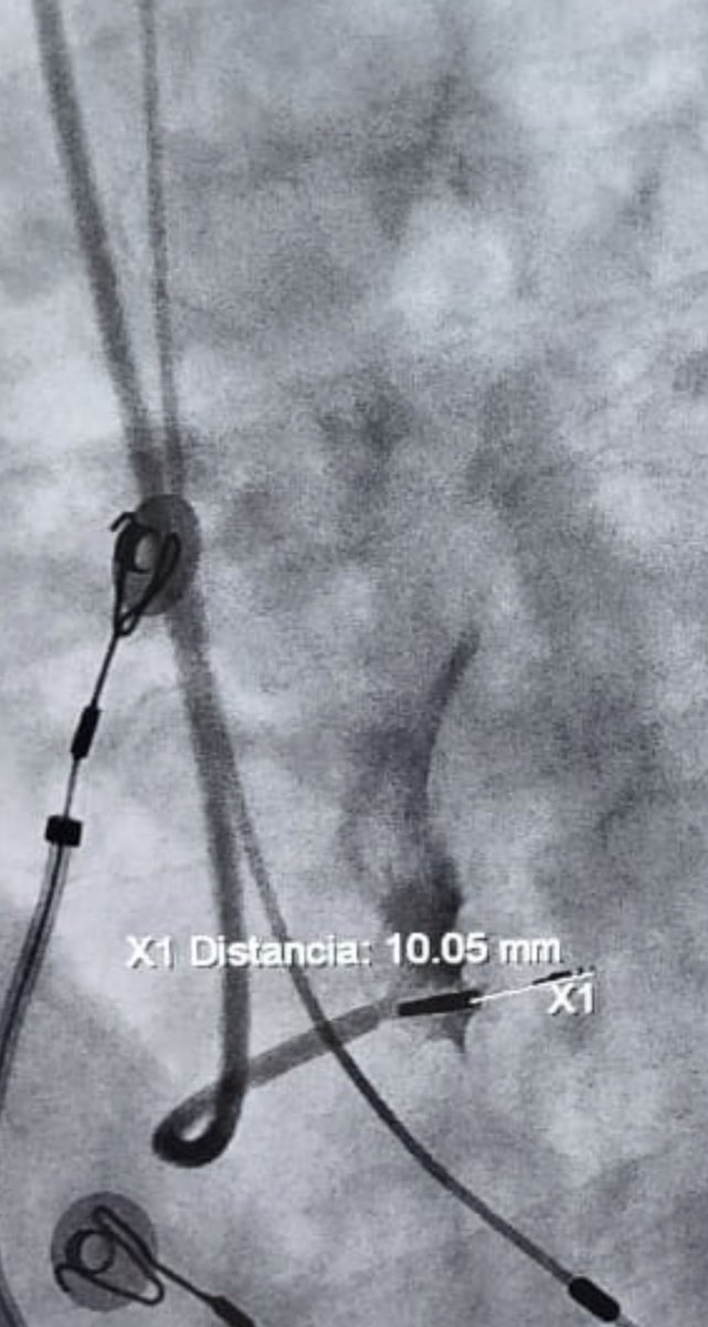diegopserranop's tweet photo. Estimulando subendocardio izquierdo #LeftBundleBranchPacing @ArritmiasSec @LAHRSonline1 @ElectroSiac @adribaran @drjosellorente @drgomezmacias @DiegoEgas1 @prisrodriguez07 @JavierPinosV1 @davichiopb7 https://t.co/VARYJbT1sc