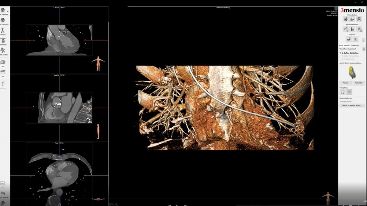 GilbertTangMD's tweet photo. My last #3Mensio CT workup video tutorial: #VIMAC #TMVR. Hope you've all found these videos helpful! All free on my @YouTube channel & @PCRonline. @sbrugaletta @nicolo_piazza @JoaoLCavalcante @OKhaliqueMD @DeeDeeWangMD @MayraGuerreroMD @azeemlatib @TAVRBot
https://t.co/I58vWRFewL https://t.co/VvURkqOCZr