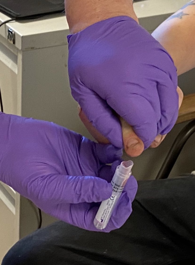 WessexVans's tweet photo. what an amazing start to the    @NHSEngland  Blood Bourne Virus Needs Assessment over the last three days we have tested a massive 118 people for the  Blood Borne Virus Needs Assessment. This is phenomenal work well done everyone 
@HepatitisCTrust @HepC_U_Later #HepCULater https://t.co/trKQHP2r9Q