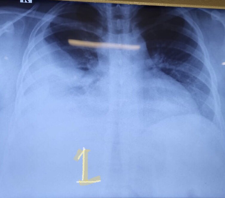 A 26-year-old-female, obese with no other comorbids was hospitalised with fever and gradually progressive exertional dyspnea of 2 weeks duration - TUS revealed multiseptated effusion on right side- chest radiograph (ignore light artefact) is shown: