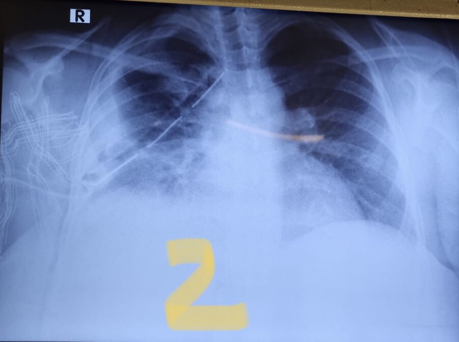 Post-procedure radiograph showed some remaining fluid collections- 
One injection streptokinase (1.5 mu) was divided in 3 equal doses and injected intrapleurally once daily that lead to removal of 1200 ml fluid volume-