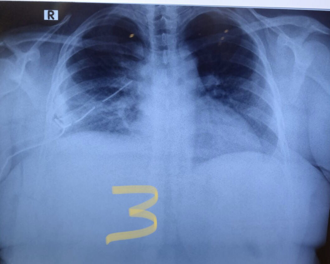 Along with clinical improvement in dyspnea, there was much improvement in radiological opacity and drain was successfully removed-