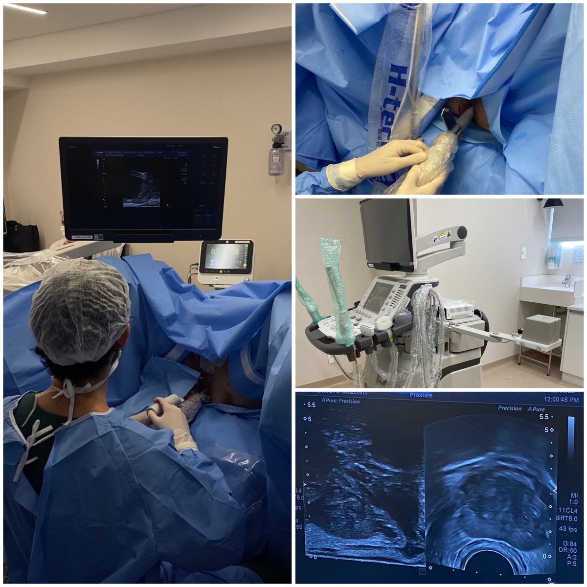 Leonardo Gomes (@leogomeslopes) on Twitter photo The era of TRANSPERINEAL prostate biopsy has began in our institution!
❌Less retal bleeding
❌NO infection
✅Better Pca detection
We finally started our way to #trexit
And we hope to see this movement grow in Brazil.
<a href="/ALDCAbreu/">Dr Andre Abreu</a> <a href="/gutoniazzo/">Gustavo Piazza Toniazzo</a> <a href="/wroclawski_uro/">Marcelo Wroclawski</a> <a href="/mateusurologia/">Mateus Furtado Rocha</a> The era of TRANSPERINEAL prostate biopsy has began in our institution!
❌Less retal bleeding
❌NO infection
✅Better Pca detection
We finally started our way to #trexit
And we hope to see this movement grow in Brazil.
<a href="/ALDCAbreu/">Dr Andre Abreu</a> <a href="/gutoniazzo/">Gustavo Piazza Toniazzo</a> <a href="/wroclawski_uro/">Marcelo Wroclawski</a> <a href="/mateusurologia/">Mateus Furtado Rocha</a>