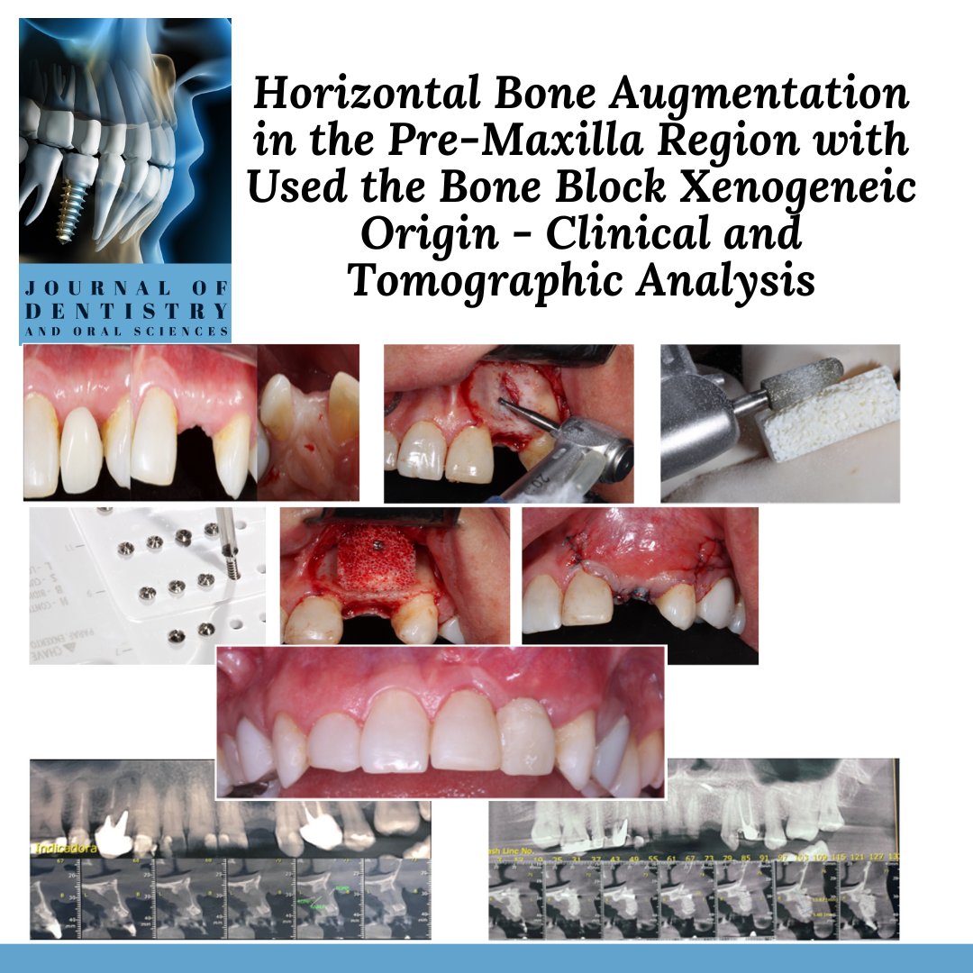 Recently published case: Horizontal Bone Augmentation in the Pre-Maxilla Region with Used the Bone Block Xenogeneic Origin - Clinical and Tomographic Analysis

Read the full-length paper via following link: doi.org/10.37191/Mapsc…
#maxillofacial #clinicalanalysis #dentistry