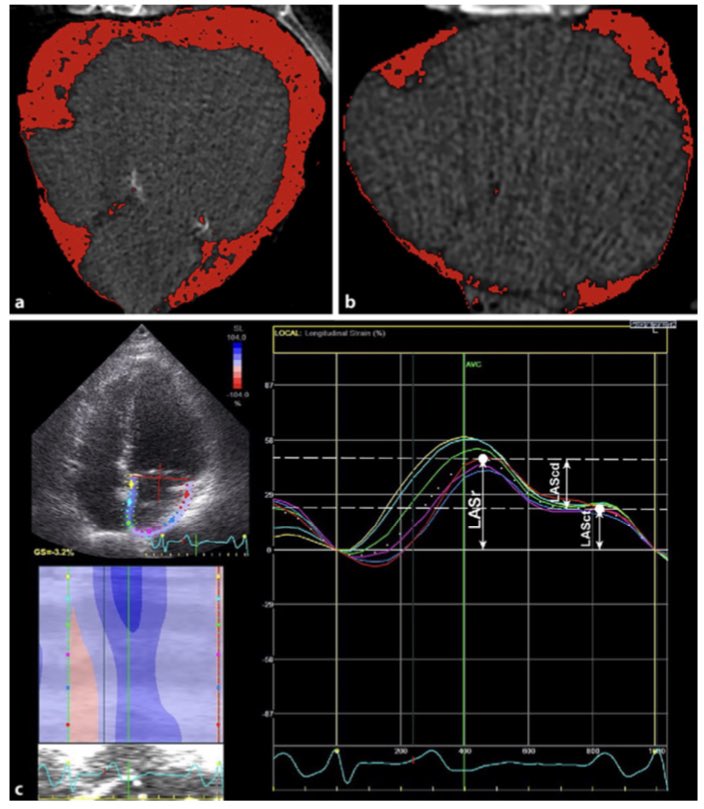 New concepts in #AFib 👉🏻Electrogram-, imaging-, and biomarker-derived parameter to assess atrial cardiomyopathy will likely impact how AF is clinically classified and managed in the future. 📖 bit.ly/3BFzeVo @SpringerNature @DGK_org @HermansBJM @MirandaBijvoet