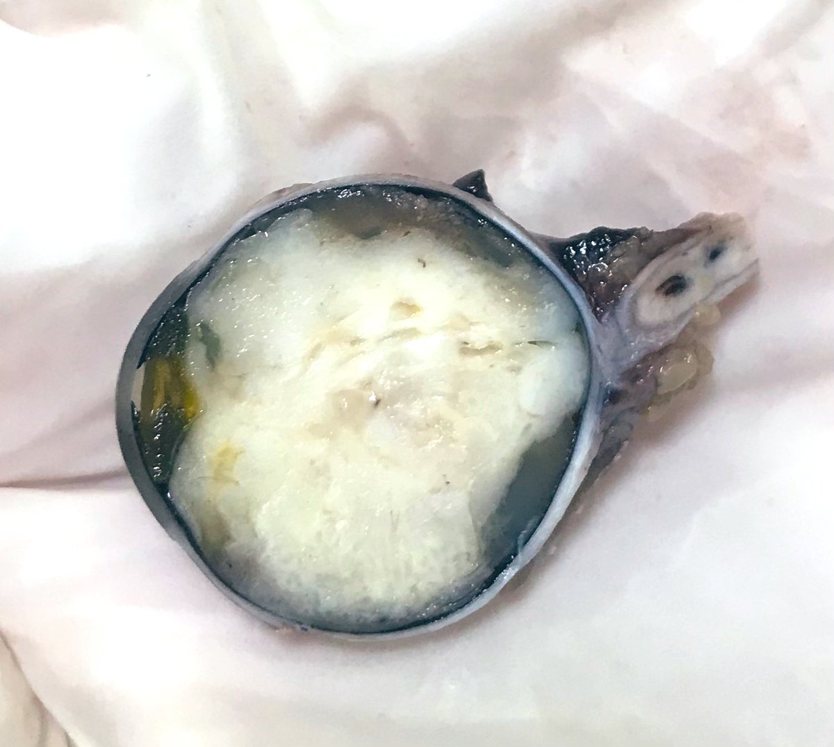 ArezuRhn's tweet photo. A 2-year-old girl with eye globe tumor
Your diagnosis?
#Pathology  #Pathology♥️ #TUMS
#PathTwitter https://t.co/m06ESg3olO