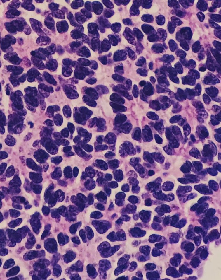 ArezuRhn's tweet photo. A 2-year-old girl with eye globe tumor
Your diagnosis?
#Pathology  #Pathology♥️ #TUMS
#PathTwitter https://t.co/m06ESg3olO