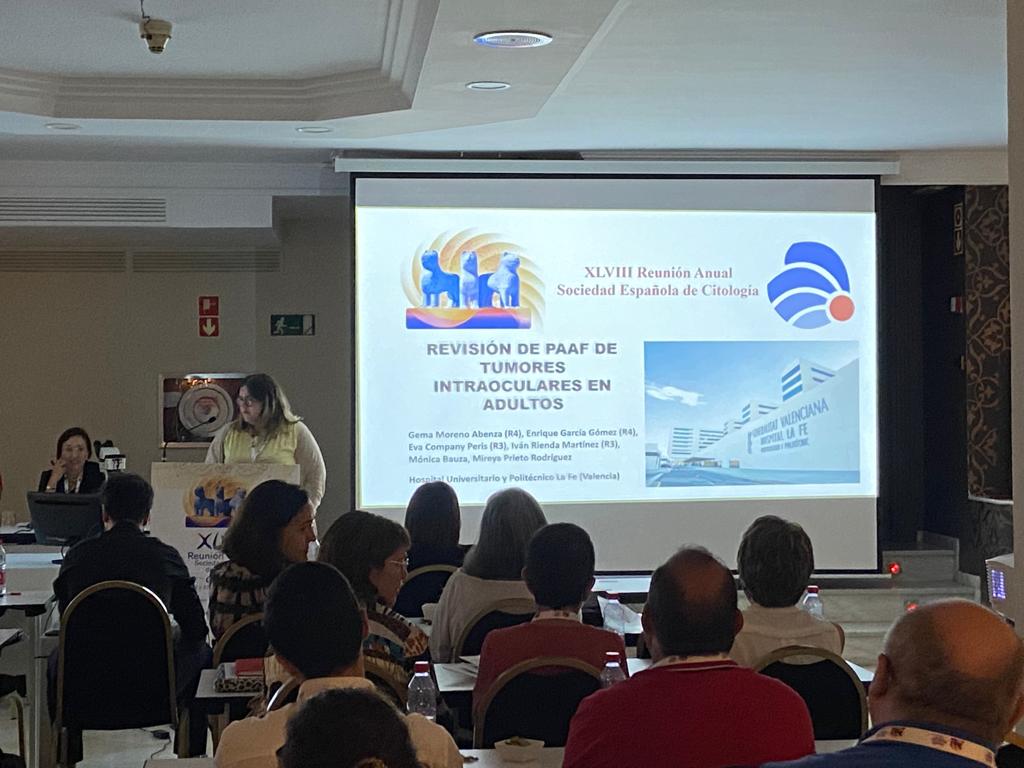 PatolegsLaFe's tweet photo. Nuestra excelente residente @gemamoreno91 ha presentado en #sec2022G una revisión de PAAF de tumores intraoculares en adultos sobre una serie histórica en nuestro centro. @SECitologia @SEAP_IAP #pathresidents. Un abrazo Gema! bon treball!!! Eres una gran profesional. #cytology https://t.co/R86mmLl4L0