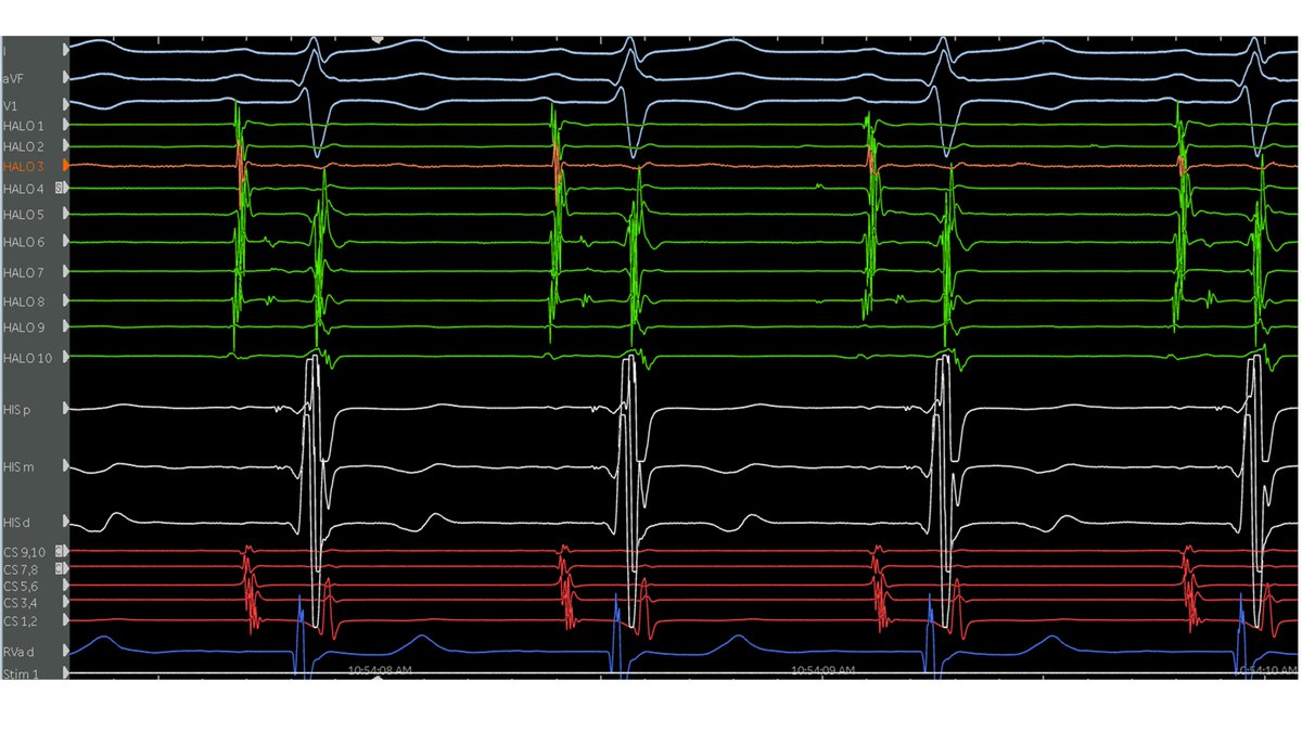 An EP study in 3 slides. #EPeeps #CardioTwitter @PennCardiology