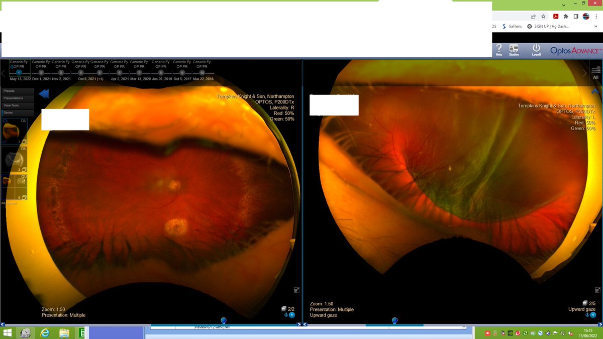 ukisop's tweet photo. These wide angle retinal images images show a retinal detachment on the left eye. If a patient announces a sudden onset of flashes and floaters in one eye, they should urgently visit a clinic to get a retinal images taken. https://t.co/OylXca99JA