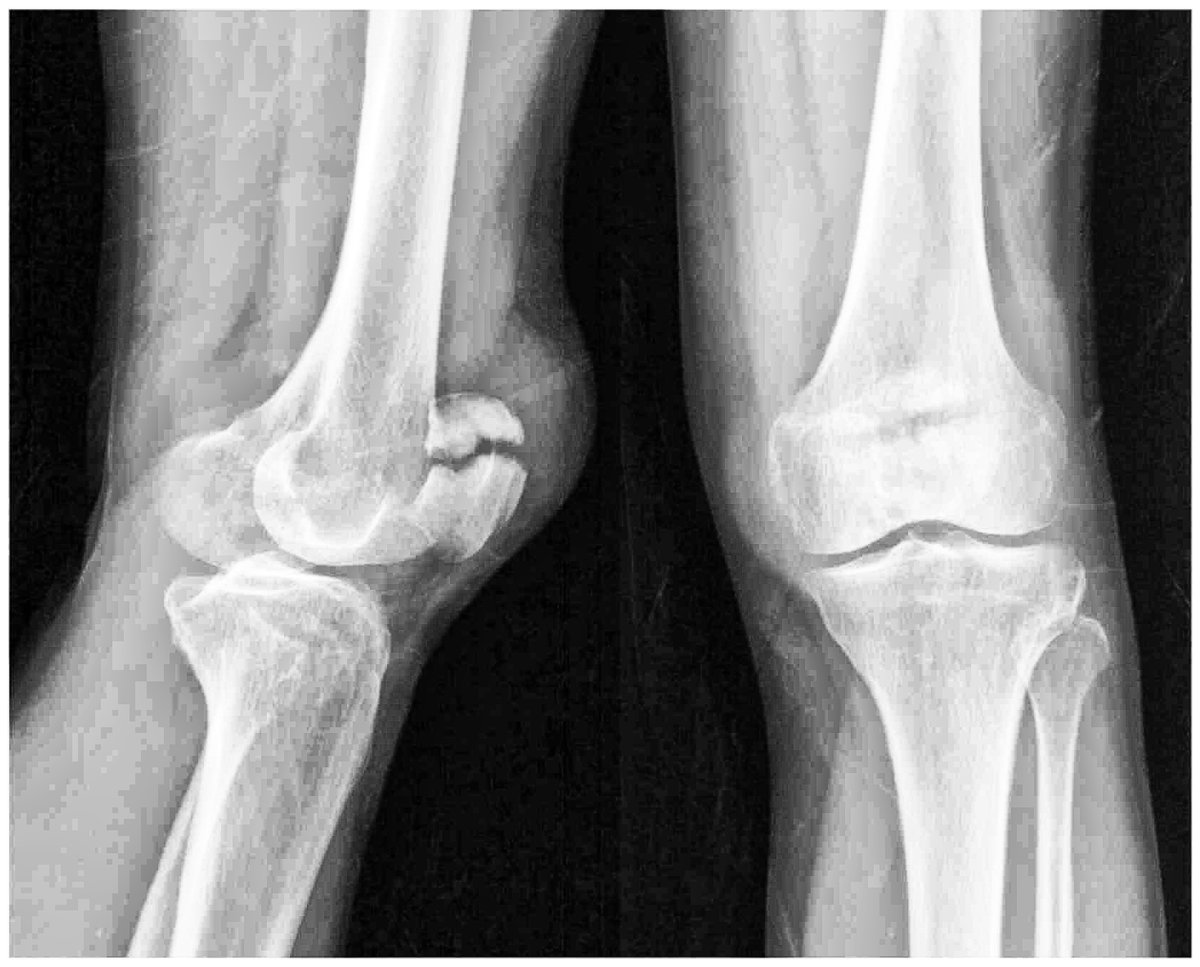 A 60-year-old with 1 week old patella fracture presents for ORIF without DVT prophylaxis. Is POCUS vascular ultrasound mandatory to rule out DVT prior to surgery? #DVT #patellafracture