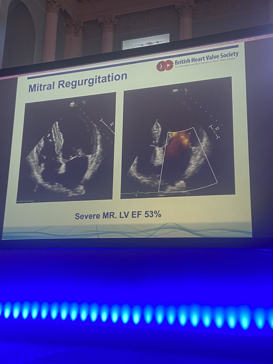 BSCImaging's tweet image. It was an honour to have @dr_benoy_n_shah President of @BrHeartValveSoc discuss the role of #multimodalityimaging in #valvularheartdisease - the most beautiful imaging in the most beautiful of venues 🤩 #echofirst #bathbsci2022