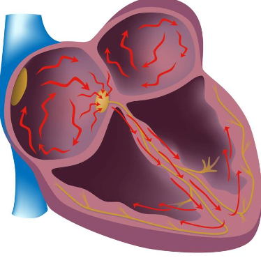 ChartAcademy's tweet photo. #AFIBmonth2022
✅3-5 million in the US-160,000 new cases reported annually
✅AF causes 20% of all ischemic strokes
for more visit: https://t.co/WLeBmRItHR
#EPeeps #EPcourse #LearnEP #VivaEP #afib #tachycardia #arrhythmia #cardiology #CardiacEP #nurse #biomed #radtech #CVT https://t.co/iuxEPI3bMm
