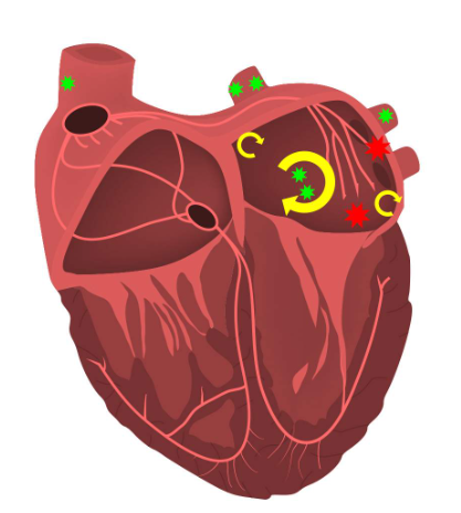 ChartAcademy's tweet photo. #AFIBmonth2022
✅3-5 million in the US-160,000 new cases reported annually
✅AF causes 20% of all ischemic strokes
for more visit: https://t.co/WLeBmRItHR
#EPeeps #EPcourse #LearnEP #VivaEP #afib #tachycardia #arrhythmia #cardiology #CardiacEP #nurse #biomed #radtech #CVT https://t.co/iuxEPI3bMm