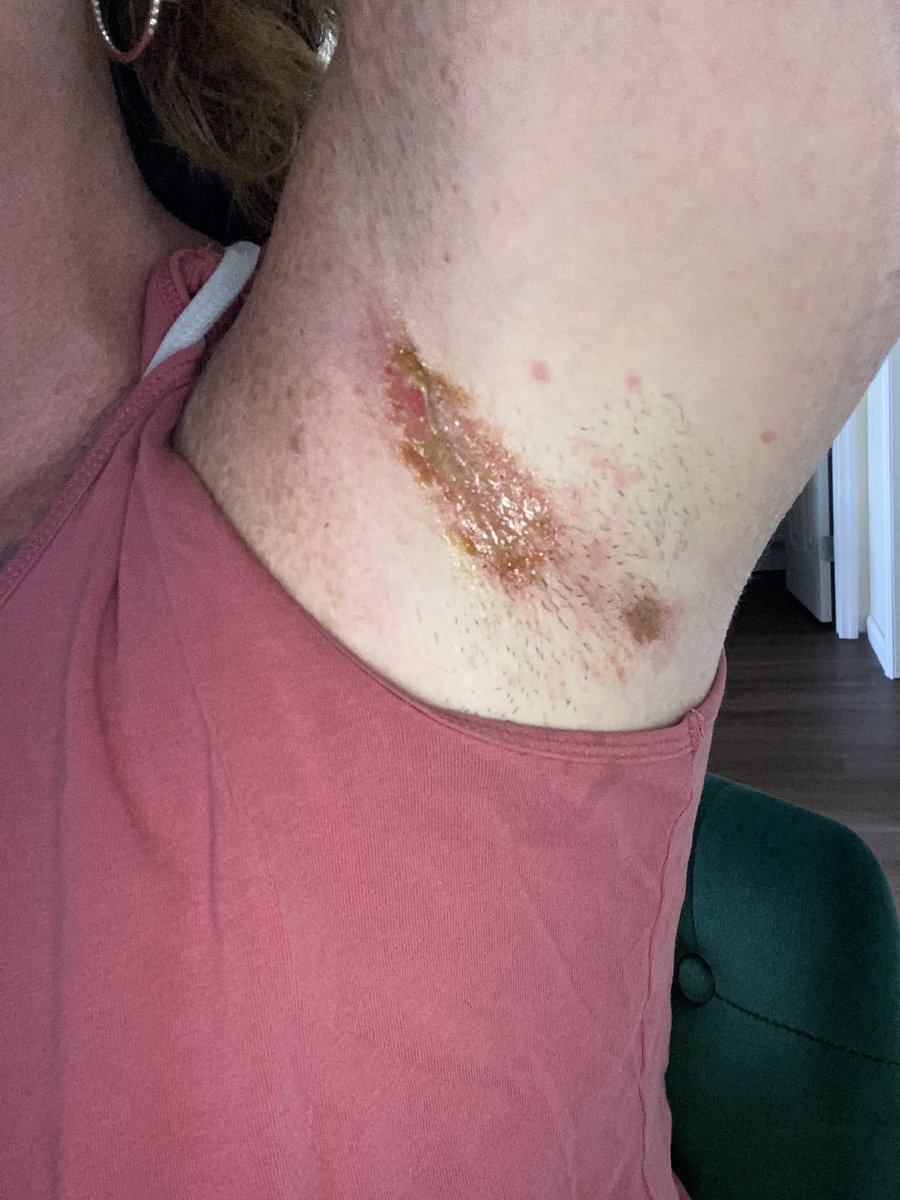 mbethfinn's tweet photo. @OldSpice hay guys, wassup I used Old Spice Fiji for two days and now it hurts to lift my arm and have a huge burn, this ain’t normal….any explanation or suggestions to help me out? Excuse the hair, I haven’t been able to shave since your deodorant burned me. https://t.co/XeMMJ8AVU8