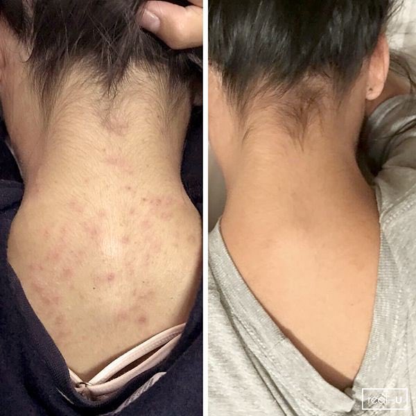 Kumpulan produk penghilang jerawat punggung!

a thread