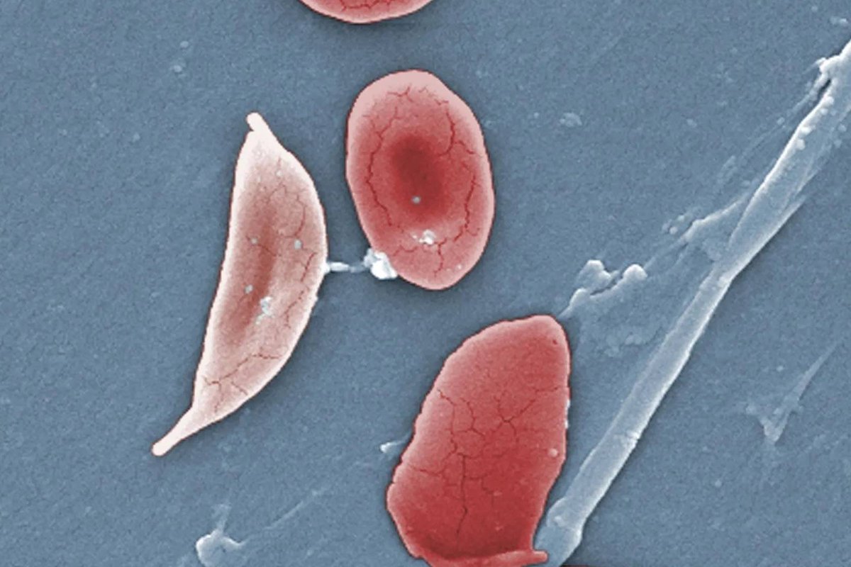 Memej99's tweet photo. Too Few Kids with #SickleCellDisease Get #StrokeScreening, #Treatment, CDC Finds
Fewer than half of children in the United States with #SCD get a needed screening for #stroke, & only about half or fewer get a treatment that can help with #pain & #anemia.
https://t.co/RyfHl1g1sV https://t.co/iiROUu2LA2