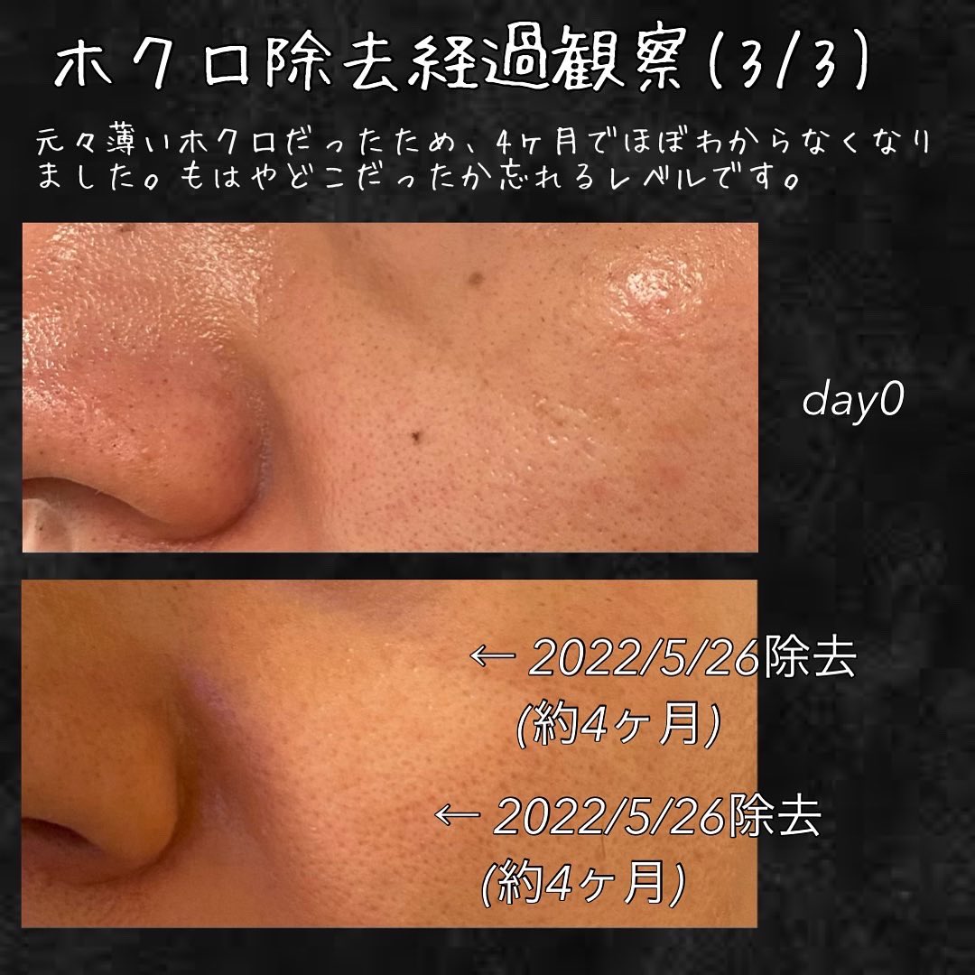 tk_hadakaizen's tweet photo. ホクロ除去のリアルをお届けしてます！

👉濃くて深いホクロは8ヶ月でようやく目立たなくなってくる。

👉薄くて小さいホクロは4ヶ月でほぼ無くなる。ただし、頬など脂肪が多いところは少し時間かかる。

ご参考まで🤗 https://t.co/HVFMgYjlKs