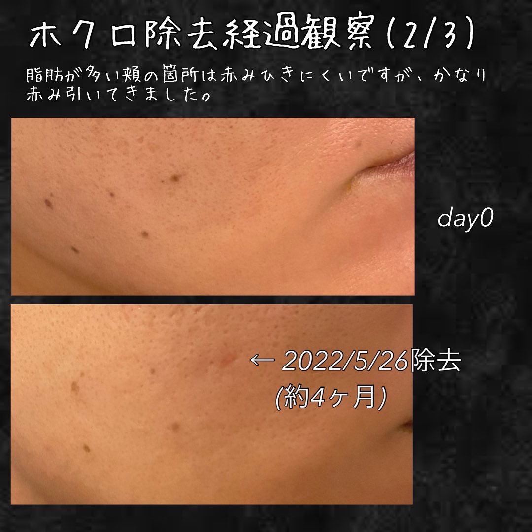 tk_hadakaizen's tweet photo. ホクロ除去のリアルをお届けしてます！

👉濃くて深いホクロは8ヶ月でようやく目立たなくなってくる。

👉薄くて小さいホクロは4ヶ月でほぼ無くなる。ただし、頬など脂肪が多いところは少し時間かかる。

ご参考まで🤗 https://t.co/HVFMgYjlKs