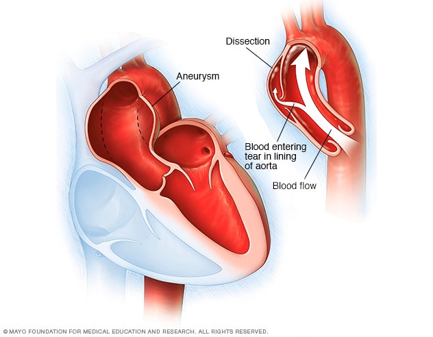 alisonkn's tweet photo. As we near the end of #AorticDissection Awareness Week, let's recap some of the basics so you'll be aware in the unlikely event that an aortic dissections happens in your family.
#ThinkAorta #AortaSupporta
1/ https://t.co/wXZmjB04Lw