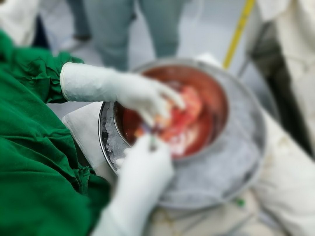 rajeevmenonsl's tweet photo. A 31yr old brain dead person in #Polonnaruwa gives life to 3 persons at the verge of death. Liver to #Kalutara, a kidney to #Colombo and the other at #Plonnaruwa itself. 🙏To the young wife and mother of deceased for consenting for the #organdonation
#SriLanka #lka #lifeanddeath https://t.co/7NkVdcKpVm