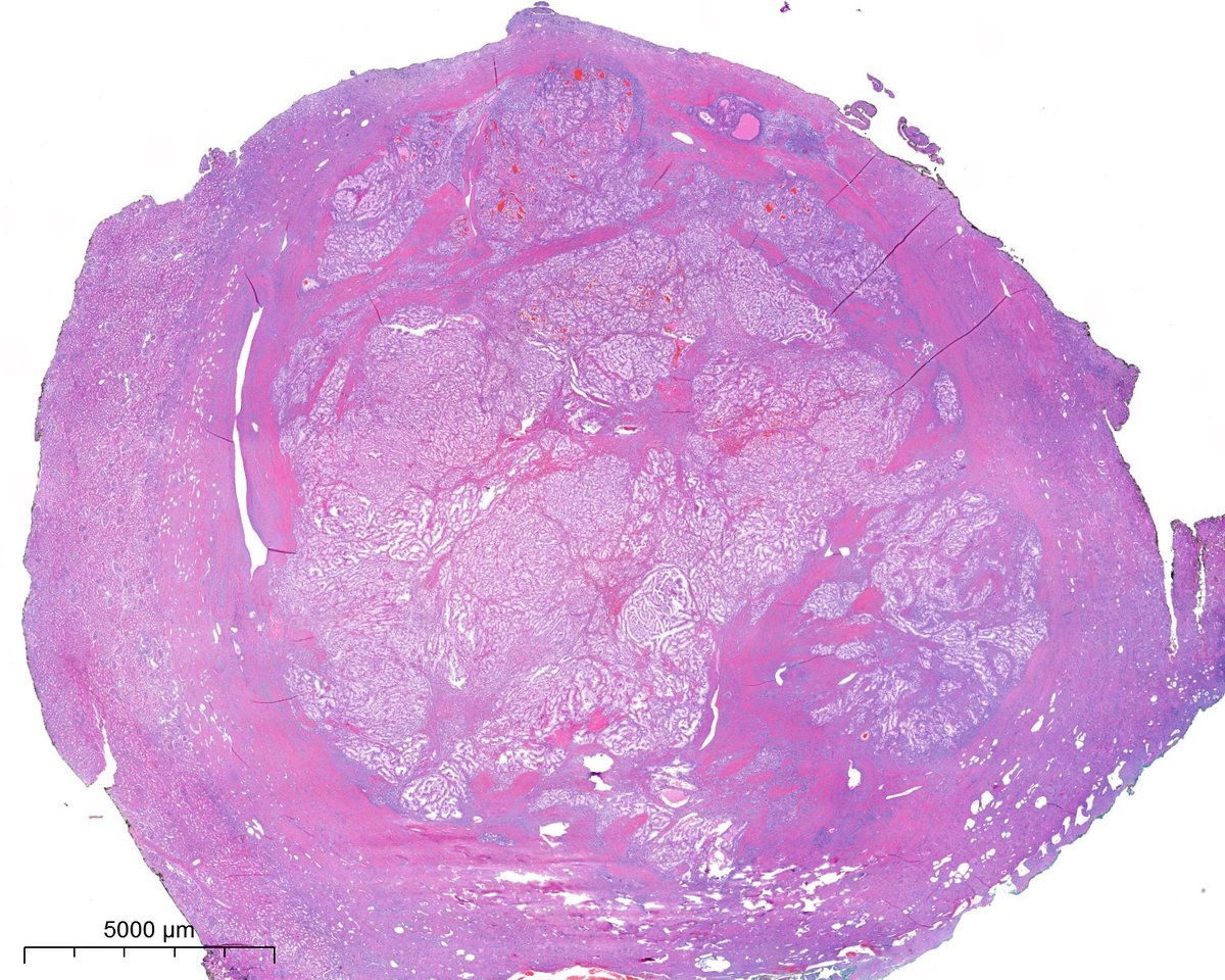 PoloniaAntonio's tweet photo. Déjà vu? be honest, without the last image (and IHC) the diagnosis would be different...#gupath @atman_ci @AkgulMd @slusagar @DrGeeONE @A_Morini_MD @ariella8 @nusrat_xahra @miss_me1986 @gonzadetoro @TristanRutland7 @LoboAnandi @JoaoPedroLobo89 @SumantaDas_7 @kis_lorand https://t.co/lD3mRJWW4P