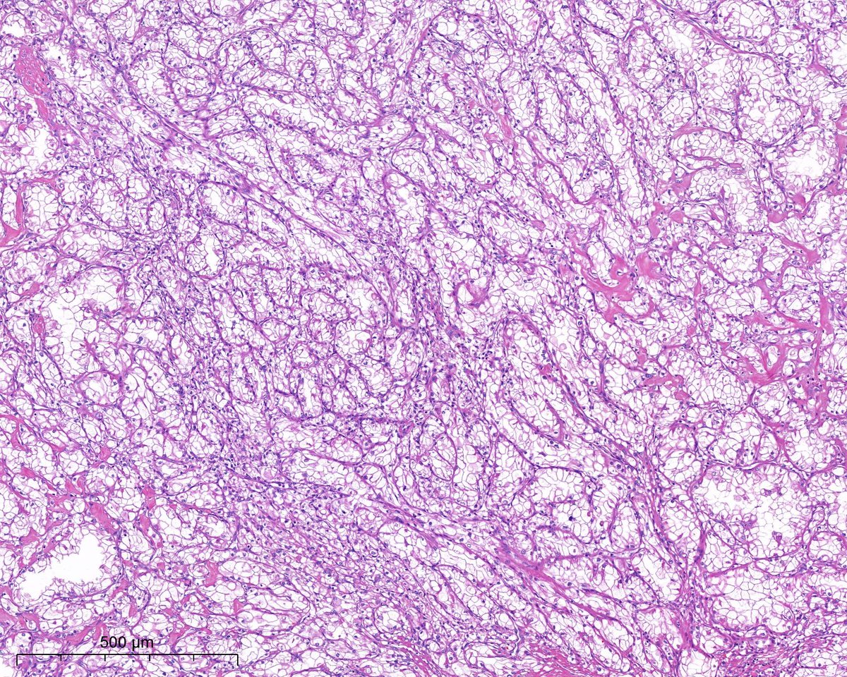 PoloniaAntonio's tweet photo. Déjà vu? be honest, without the last image (and IHC) the diagnosis would be different...#gupath @atman_ci @AkgulMd @slusagar @DrGeeONE @A_Morini_MD @ariella8 @nusrat_xahra @miss_me1986 @gonzadetoro @TristanRutland7 @LoboAnandi @JoaoPedroLobo89 @SumantaDas_7 @kis_lorand https://t.co/lD3mRJWW4P