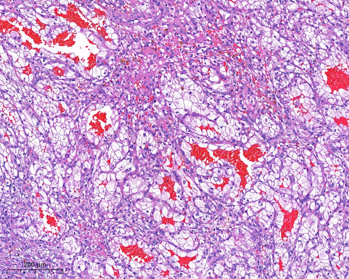 PoloniaAntonio's tweet photo. Déjà vu? be honest, without the last image (and IHC) the diagnosis would be different...#gupath @atman_ci @AkgulMd @slusagar @DrGeeONE @A_Morini_MD @ariella8 @nusrat_xahra @miss_me1986 @gonzadetoro @TristanRutland7 @LoboAnandi @JoaoPedroLobo89 @SumantaDas_7 @kis_lorand https://t.co/lD3mRJWW4P