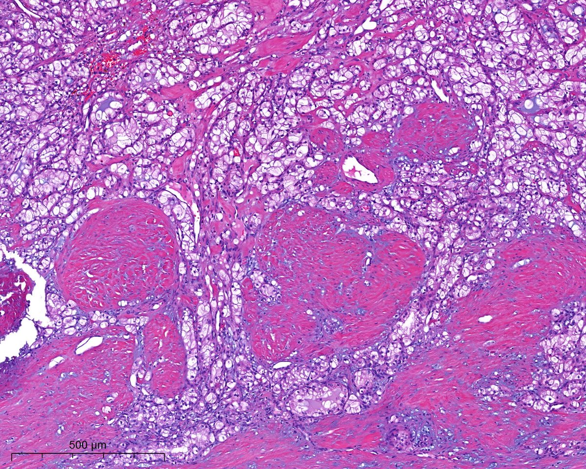PoloniaAntonio's tweet photo. Déjà vu? be honest, without the last image (and IHC) the diagnosis would be different...#gupath @atman_ci @AkgulMd @slusagar @DrGeeONE @A_Morini_MD @ariella8 @nusrat_xahra @miss_me1986 @gonzadetoro @TristanRutland7 @LoboAnandi @JoaoPedroLobo89 @SumantaDas_7 @kis_lorand https://t.co/lD3mRJWW4P