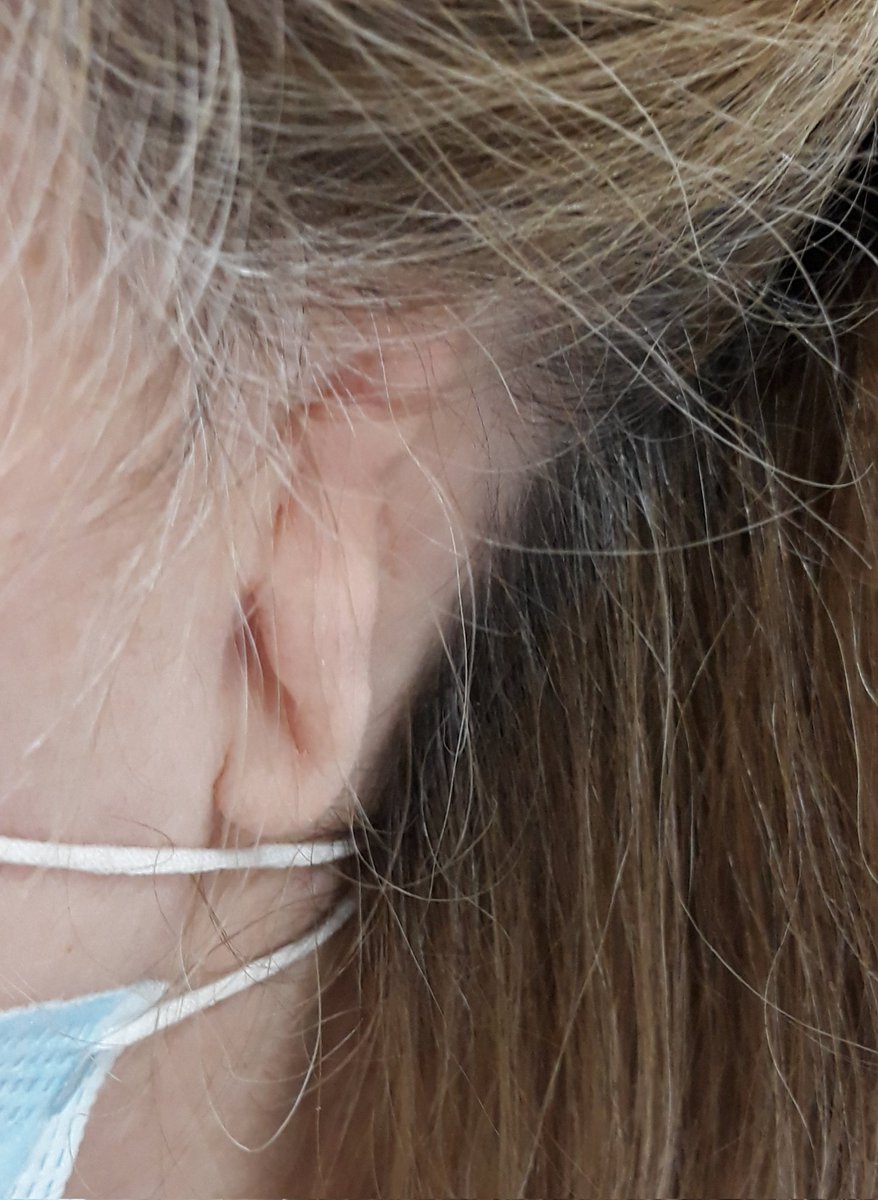 ortoarbos's tweet photo. Estas afectat de #microtia? 
Et podem ajudar!
Tant si vols mantenir el teu monyó residual, com si no tens clar en aquest moment si vols fer-te la reconstrucció quirúrgica, podem oferir-te una solució definitiva o temporal amb les epítesis de silicona.
👇🏻👇🏻 https://t.co/9uviMxIVXI