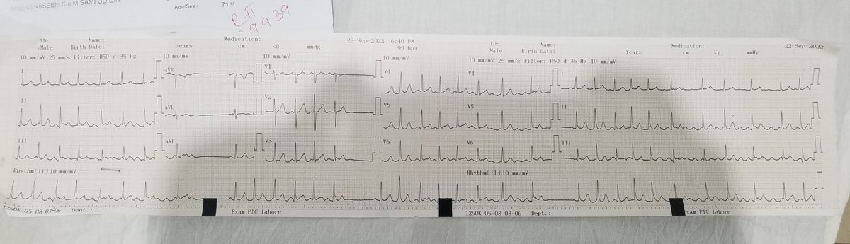 Jihadi_doc's tweet photo. A 65 years old patient presented to emergency with complaints of typical chest pain and sweating for three hours. He is diabetic hypertensive and previous history of IHD (PCI done to LAD in 2020). Don't known about this rythm any suggestions would be appreciated. https://t.co/bBWzjIueKu