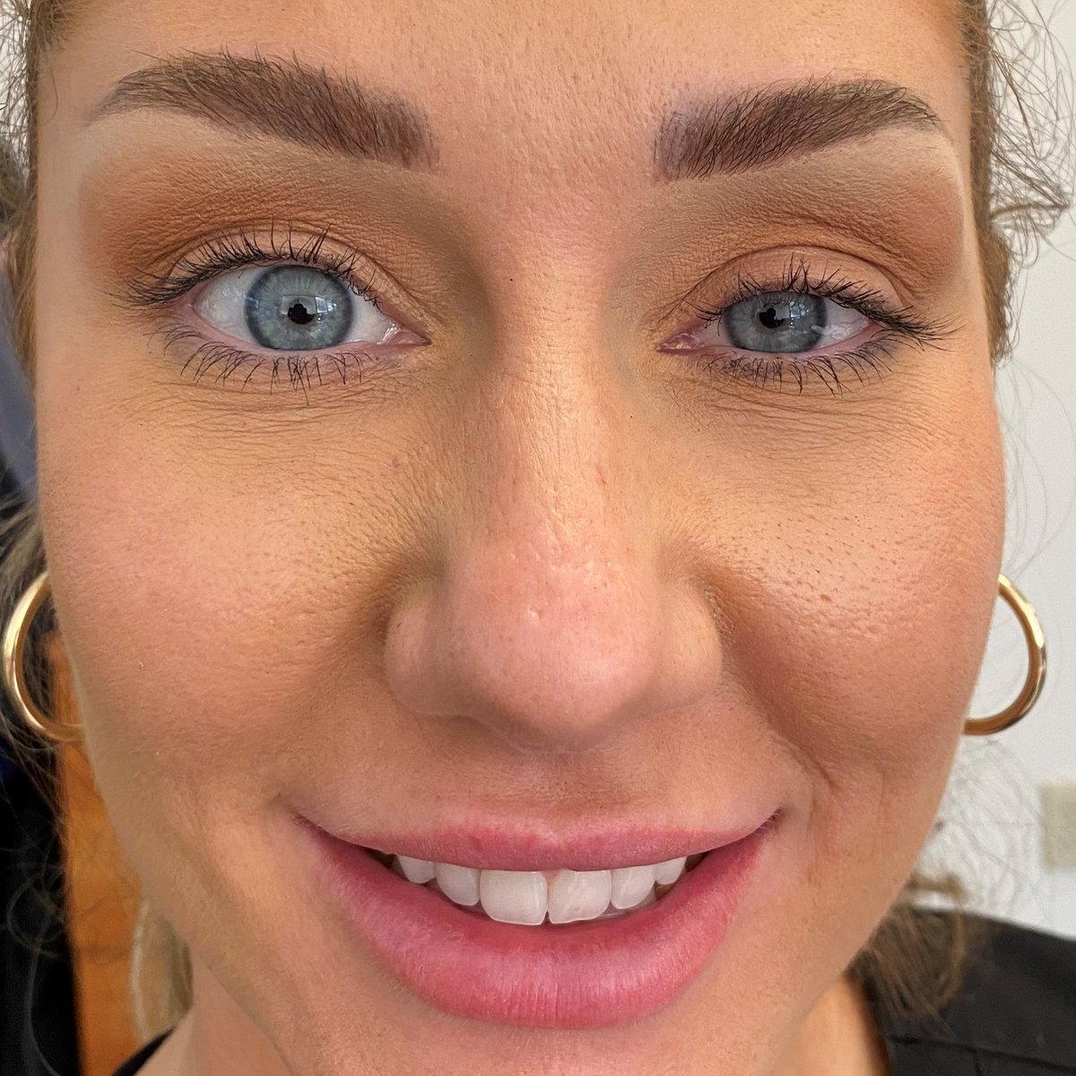 SuhEsthetics's tweet photo. Side by side real results with #Upneeq.   Our beautiful student is living proof of what a difference it can make.  Can you believe the difference between the treated eye versus the untreated eye?! One drop in each eye daily helps with low lying eyelids.  $240 for a 6 week supply. https://t.co/FrAEqTBY1Q