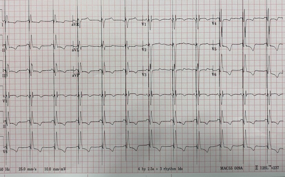 Back to back lbb pacing cases from yesterday. Both nice fat lbbb w lvsd. Very proud if my team at pmc and the care we deliver! #epeeps ⁦<a href="/BIOTRONIK_US/">BIOTRONIK US</a>⁩