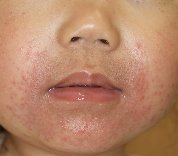 口囲皮膚炎 Twitter Search Twitter