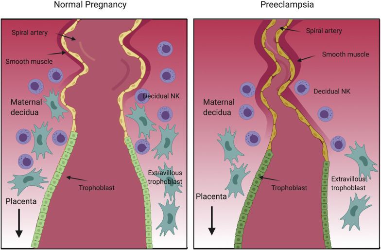 AJOG Expert Review in Preeclampsia:  Imbalances in circulating angiogenic factors in the pathophysiology of preeclampsia and related disorders - Spiral artery defects in #preeclampsia - ow.ly/a7lW50DTv4z