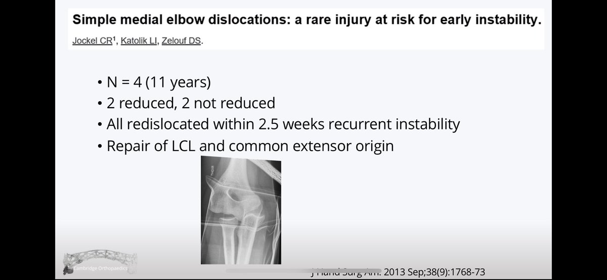 They are rare, but often highly unstable and not usually amenable to non operative treatment.
All 4 (100%) in this series redislocated within 2.5 weeks.
2/4